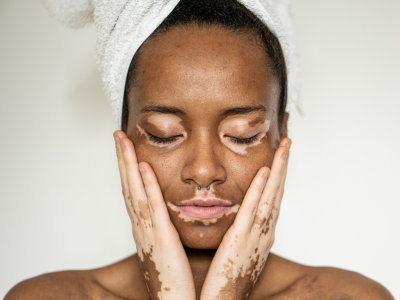 O que são manchas brancas na pele? Confira suas causas e possíveis tratamentos!